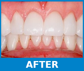 Teeth Whitening after picture